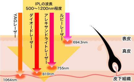ウルトラ美肌脱毛髭脱毛効果なし